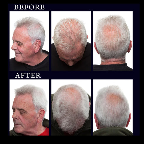 Regrowz 奇蹟生髮療程組合 Hair Growth & Thickening Treatment