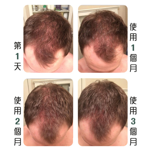 Regrowz 奇蹟生髮療程組合 Hair Growth & Thickening Treatment