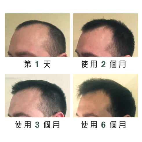 Regrowz 奇蹟生髮療程組合 Hair Growth & Thickening Treatment