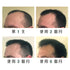 Regrowz 奇蹟生髮療程組合 Hair Growth & Thickening Treatment